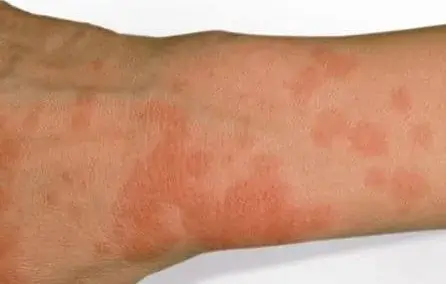 خفايا حساسية الشمس: الحقيقة اللي شركات التجميل مابتقولهاش للناس
