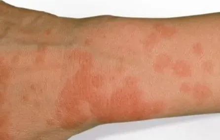 خفايا حساسية الشمس: الحقيقة اللي شركات التجميل مابتقولهاش للناس