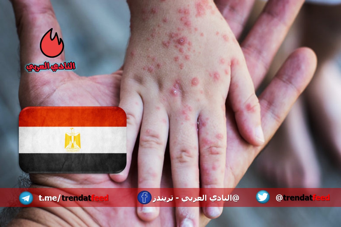وزارة التربية تتخذ قرارات عاجلة لمكافحة وباء الجدري المائي في مصر 